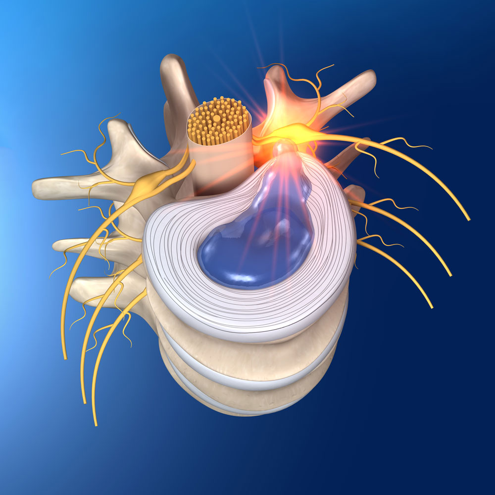 Symptoms of Spine Disorders - Cantor Spine Institute